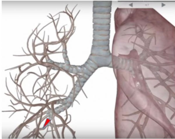 National recognition for excellence brought out by Physiotherapy in medical college for tooth stuck in lung